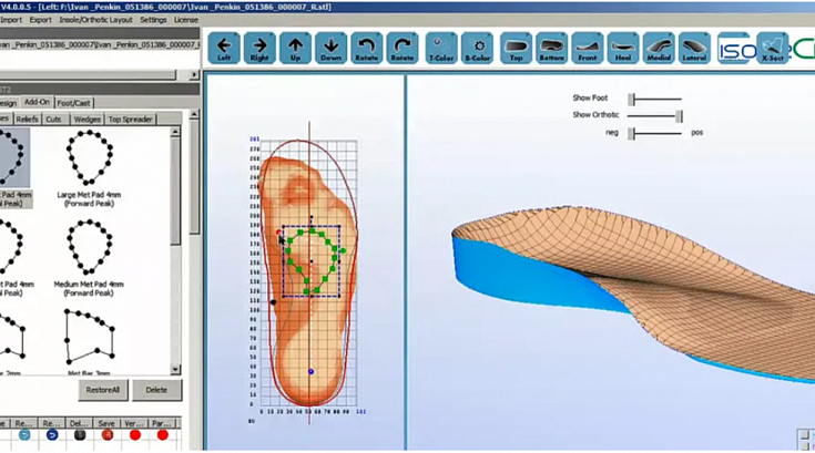 3D-печать ортопедических стелек